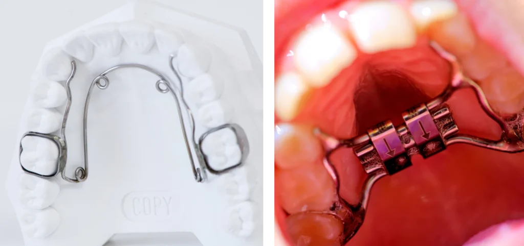 orthodontie enfant disjoncteur quad helix